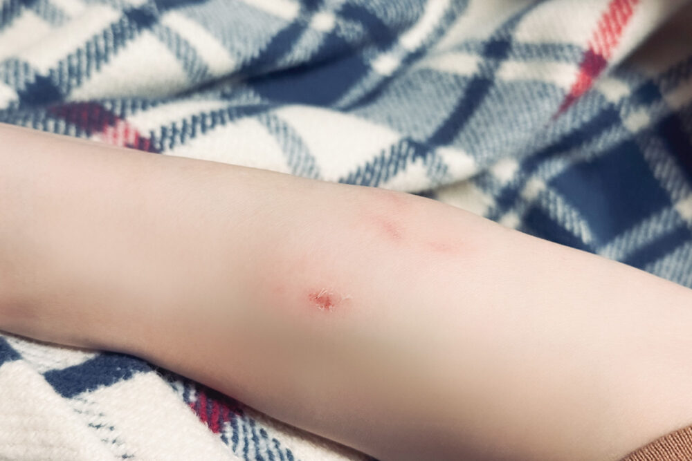 犬に噛まれたあと